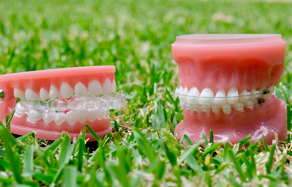 Clear Aligners vs Braces - Weighing up your options