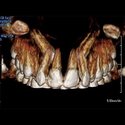 Cone Beam X-ray of Complex Case