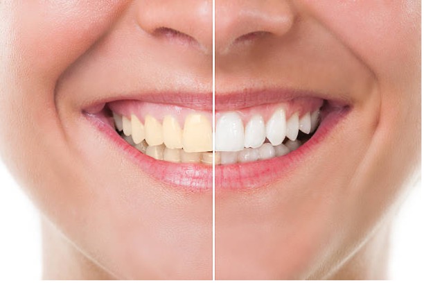 Teeth Whitening after Orthodontic Treatment
